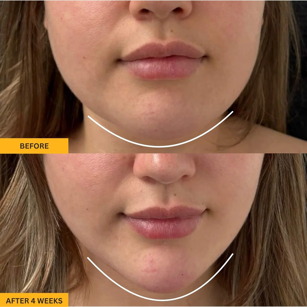 LYMEA™ Pro – Jawline & Chin Sculpting Tool