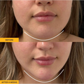 LYMEA™ Pro – Jawline & Chin Sculpting Tool