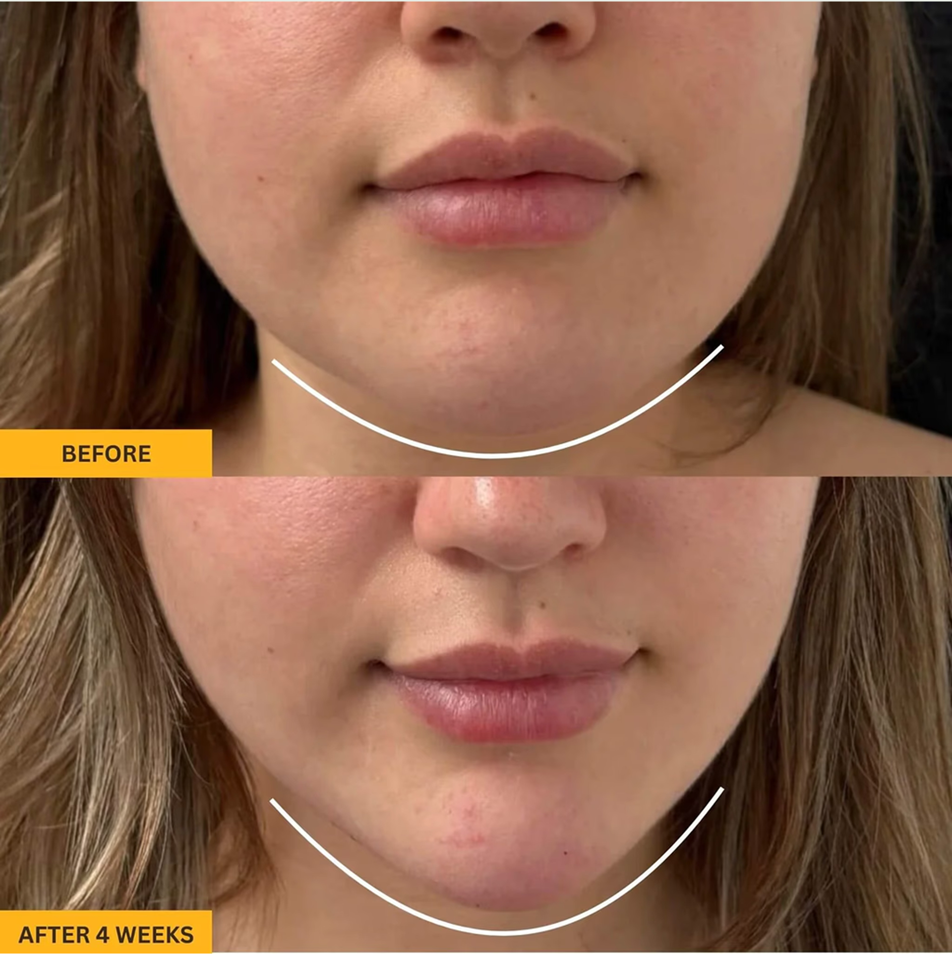 LYMEA™ Pro – Jawline & Chin Sculpting Tool