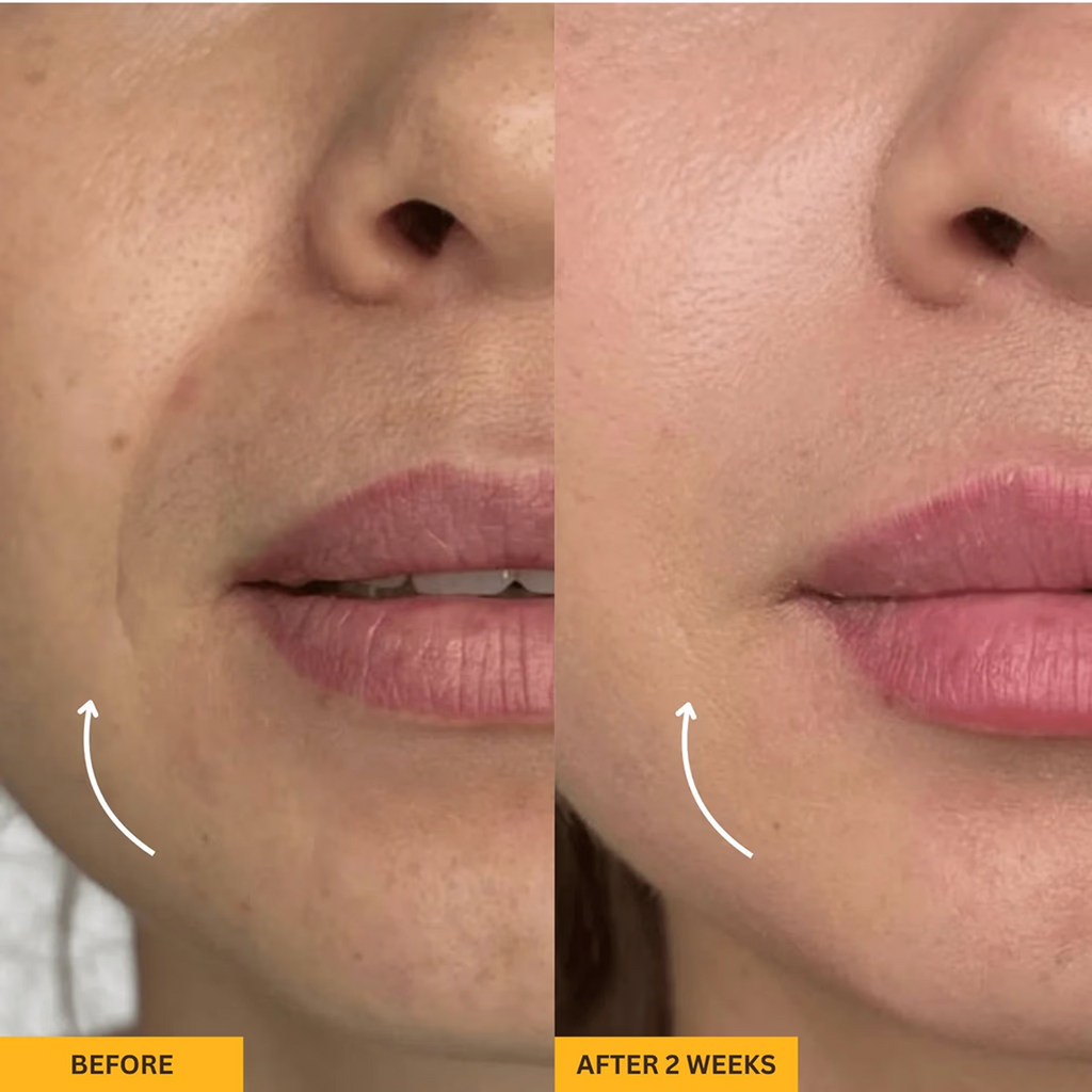 LYMEA™ Pro – Jawline & Chin Sculpting Tool